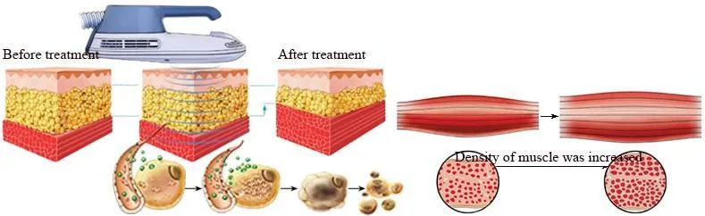 4D Cryolipolysis EMS Therapy Machine with Electromagnetic Stimulation for Body Slimming